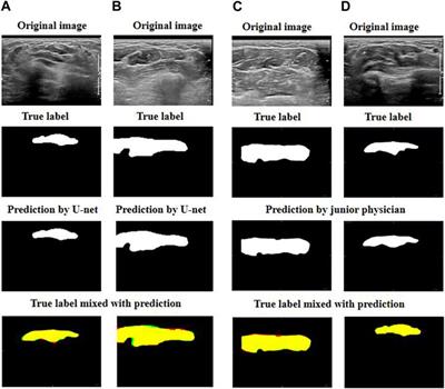 Deep learning for the rapid automatic segmentation of forearm muscle boundaries from ultrasound datasets